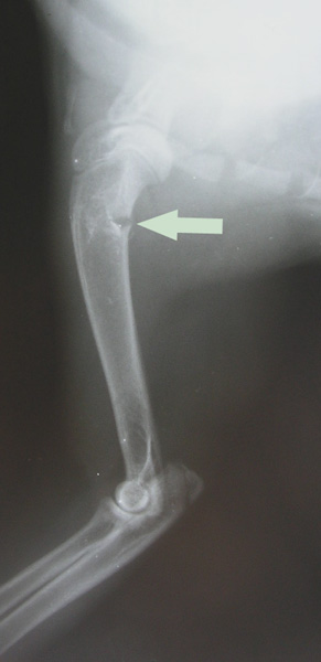 Спонтанный перелом плечевой кости