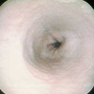 Желудочно-кишечный сфинктер несколько смещен в сторону относительно главной продольной оси пищевода
