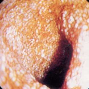 имфангиэктазия в тонком кишечнике у шестимесячного пуделя с выпотом в грудную полость, асцитом и пангипопротеинемией